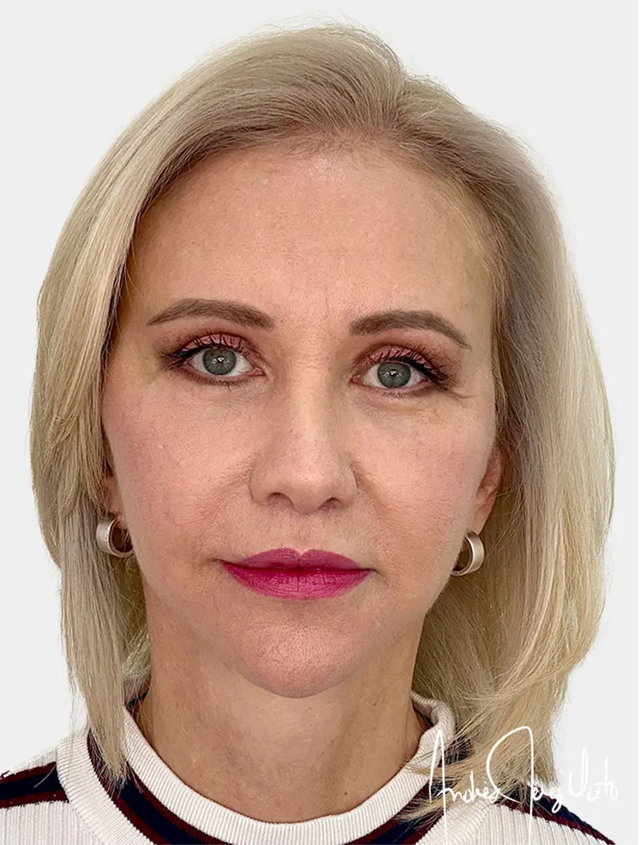 Resultado Lip Lift 2